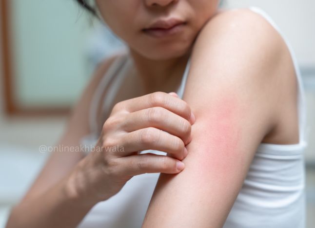 Skin rash - onlineakhbarwala